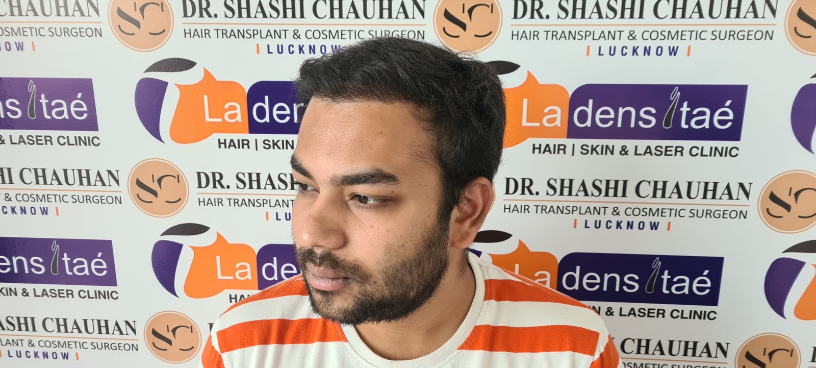Arnav Dayal After Hair Transplant